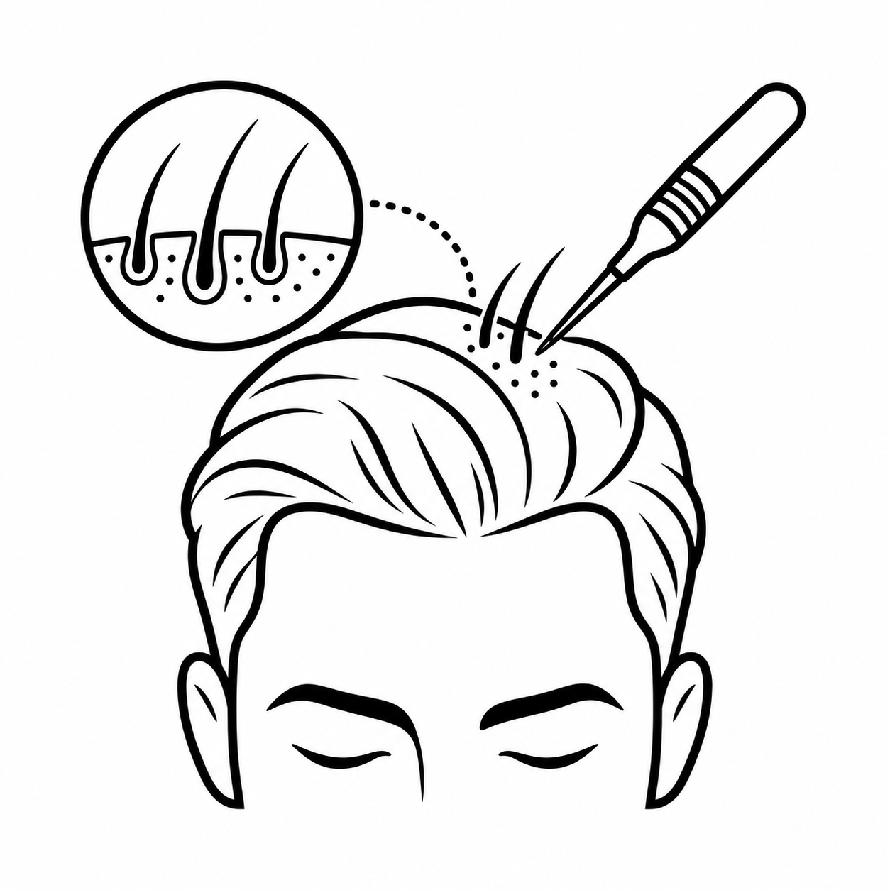 Biofibre® haarimplantatie